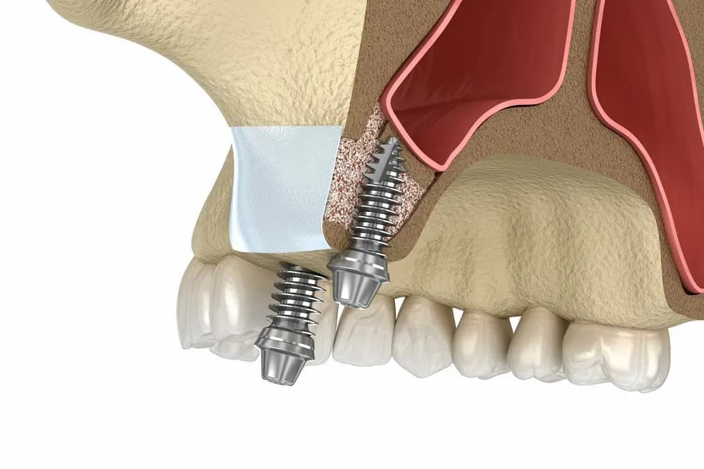 Diş həkimi implant nahiyəsini yoxlayır